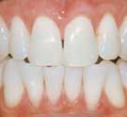 هشدار برای افرادی که از دندان مصنوعی استفاده میکنند