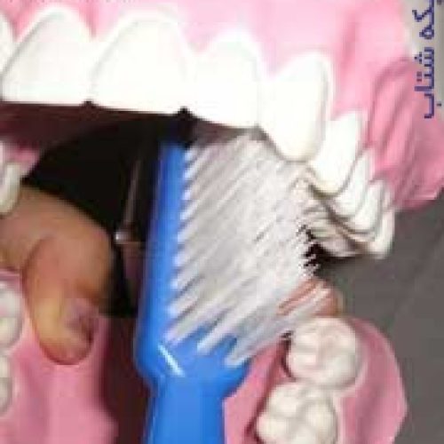 مولاژ دندان با نمایش رباط پریودنتال