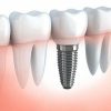 انجام کلیه خدمات دندانپزشکی،ایمپلنت کره ای و اروپایی درجه یک،جراحی دندانو جراحی ایمپلنت