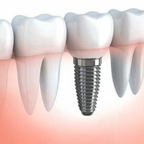 انجام کلیه خدمات دندانپزشکی،ایمپلنت کره ای و اروپایی درجه یک،جراحی دندانو جراحی ایمپلنت