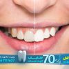 انجام تخصصی بریج دندان و ترمیم دندان با تخفیف 70 درصدی