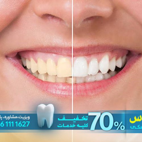 انجام درمان ارتودنسی برای دندان‌ها و ترمیمی با تخفیف 70 درصدی