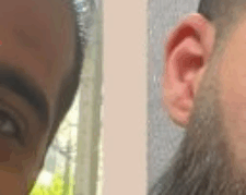 کاشت مو و ابرو با پرداخت 8 تومن و قسطی