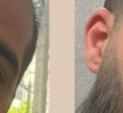 کاشت مو و ابرو با پرداخت 8 تومن و قسطی