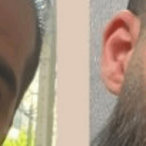 کاشت مو و ابرو با پرداخت 8 تومن و قسطی