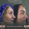 کاشت مو و ابرو با پرداخت 8 تومن و قسطی