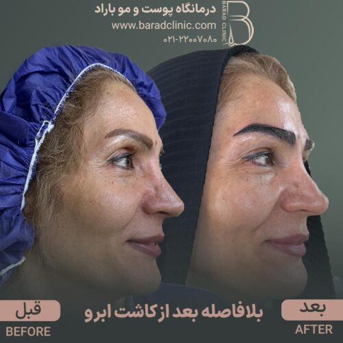 کاشت مو و ابرو با پرداخت 8 تومن و قسطی