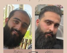 کاشت مو و ابرو با پرداخت 8 تومن و قسطی